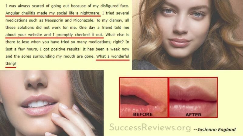 Angular Cheilitis Free Forever Review - Solution or Scam?