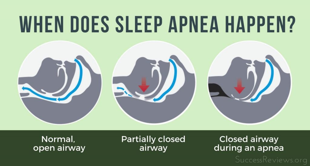 Stop Snoring Exercise Program When does sleep apnea happen?